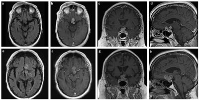 Molecular Profile of a Pituitary Rhabdomyosarcoma Arising From a Pituitary Macroadenoma: A Case Report